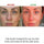 How Red Light Therapy Helps Reduce Acne and Cystic Acne