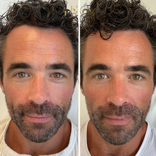 Fine Lines Before and After