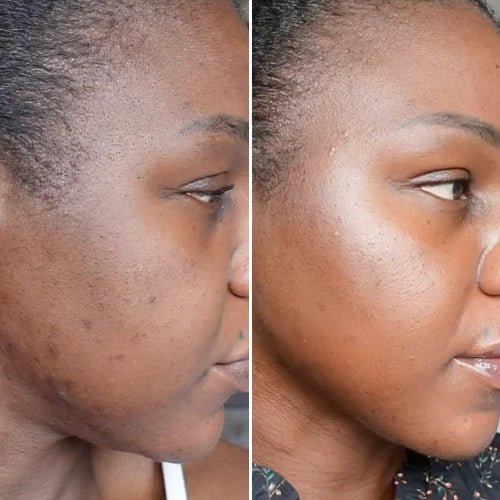 Even Skin Tone Before and After