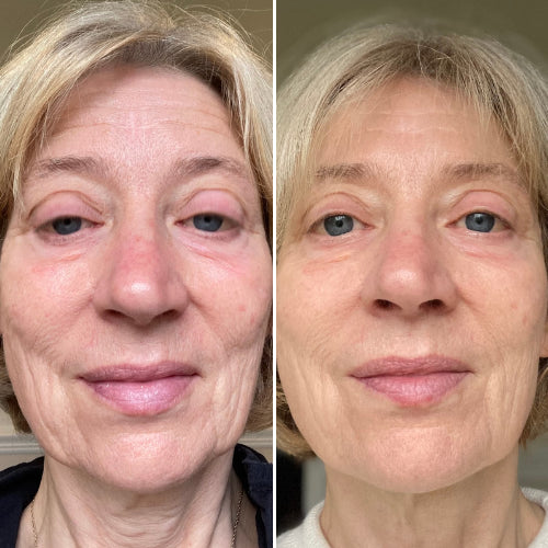 Reduce Fine Lines Before and After