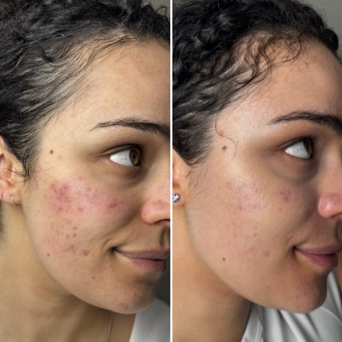 Reduce Redness Before and After